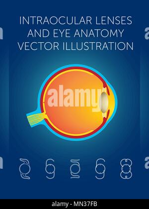 Structure schématique de l'œil et de types de lentilles intraoculaires sur fond bleu Illustration de Vecteur