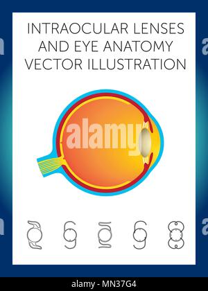 Structure schématique de l'œil et de types de lentilles intraoculaires sur fond blanc Illustration de Vecteur