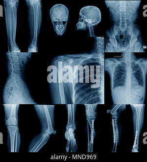 Collection x-ray image crâne, épaule, hanche, genou , et petite scoliose spinne contenu dans mixte Banque D'Images