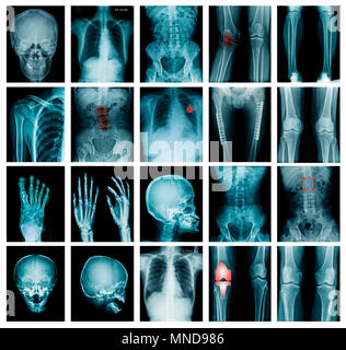 Collection x-ray image crâne, épaule, hanche, genou , et petite scoliose spinne contenu dans mixte Banque D'Images