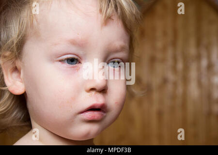 Petit garçon aux cheveux blonds et aux yeux bleus souffrant de la maladie d'une conjonctivite. Frappé de virus les yeux, ils étaient rouges et gonflées. Banque D'Images