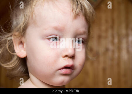 Petit garçon aux cheveux blonds et aux yeux bleus souffrant de la maladie d'une conjonctivite. Frappé de virus les yeux, ils étaient rouges et gonflées. Banque D'Images