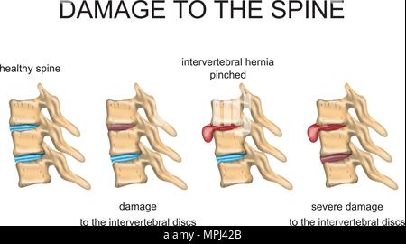 ILLUSTRATION D'un disque intervertébral sain, le disque intervertébral endommagé, hernie discale. Illustration de Vecteur