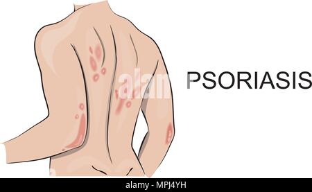 Illustration de l'organisme humain, le rhumatisme psoriasique éruption. La dermatologie. Réaction allergique, vecteur. Illustration de Vecteur