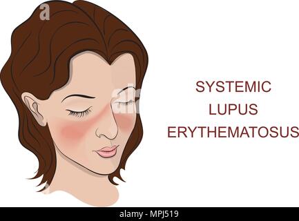 Illustration des principaux symptômes du lupus systémique, purple butterfly sur le nez et les joues. Illustration de Vecteur