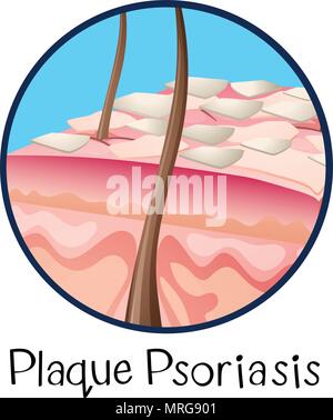 Une anatomie humaine le psoriasis en plaques illustration Illustration de Vecteur