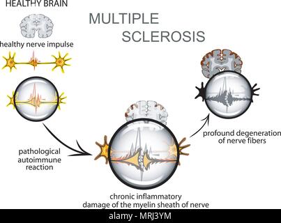 La sclérose en plaques. Le mécanisme de développement de la maladie. Illustration de Vecteur