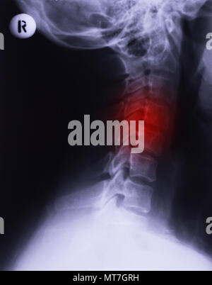 X-ray de cou, projection latérale. L'entorse cervicale de rectification de la lordose lombaire Banque D'Images