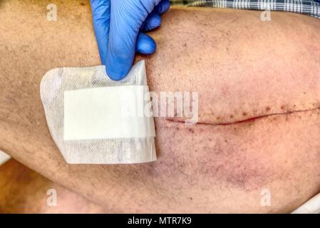 Les droits de l'ancienne cicatrice postopératoire avec jambe de hanche chirurgie. Détail de la peau avec une profonde coupure chirurgicale. Soins de santé à l'hôpital. Banque D'Images