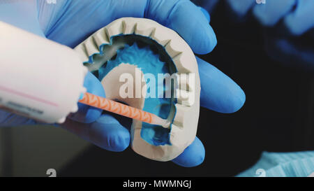 Mise en place de plaque temporaire en plastique pour les placages. Dentiste lubrifie les mâchoires 3d avec de la colle dentaire. Esthétique dentaire, médecine, stomatologie concept. Vue rapprochée Banque D'Images