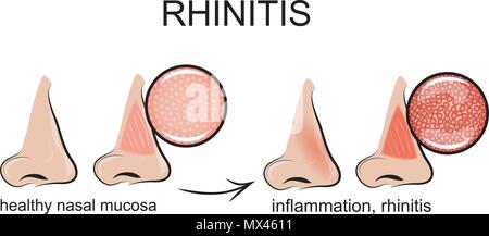 Illustration de l'inflammation de la muqueuse nasale, rhinite. Illustration de Vecteur