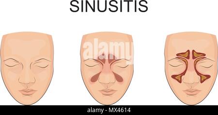 Illustration de l'oedème et l'inflammation des sinus. Illustration de Vecteur