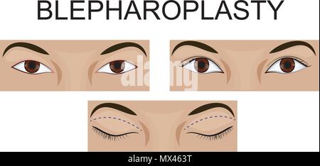 Illustration de la blépharoplastie des paupières supérieures, avant et après. Illustration de Vecteur