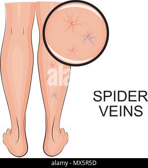 Illustration de varicosités sur les jambes varices. Illustration de Vecteur