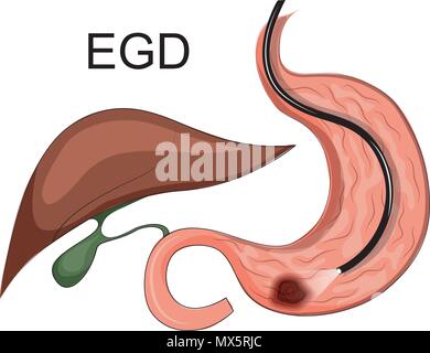 Illustration EGD, de l'ulcère de l'estomac de l'examen. Illustration de Vecteur