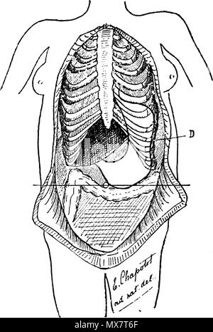 . English : Figure 18 (d'après nature). ESTOMAC AVEC BILOCULATION VERTICALE. D. Déformation du thorax, correspondant au rétrécissement de l'estomac. On voit les côtes déformées, faisant l'angle de l'onu en avant de la ligne axillaire ; the vendeurs-inclinées en bas. 1892. Le Dr Eugène Chapotot 197 EstomacCorset page068 Banque D'Images