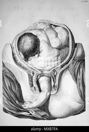 . William Smellie (1697-1763) : UN Sett de tables anatomiques avec explications et une diminution de la pratique des sages-femmes, 1754. Janvier 2008. 565 McLeod Smellie complication Banque D'Images