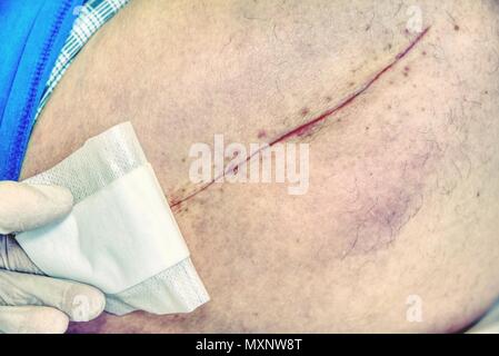 Patient avec une longue cicatrice fraîche après une chirurgie de la hanche. Macro, Human foot avec du sang cicatrice de chirurgie de la hanche. Banque D'Images