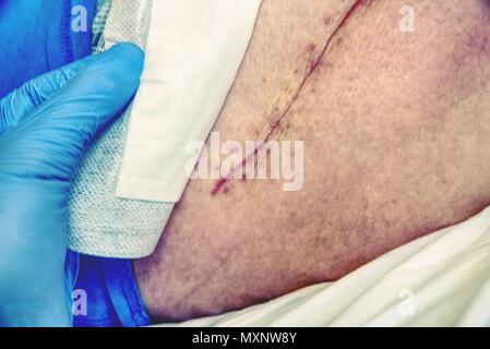 Patient avec une longue cicatrice fraîche après une chirurgie de la hanche. Macro, Human foot avec du sang cicatrice de chirurgie de la hanche. Banque D'Images