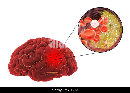 Avc dû à l'athérosclérose. Illustration d'une occlusion artérielle (voir en haut à droite) qui provoque un AVC (accident vasculaire cérébral, AVC). Ce trait est attribuable à l'accumulation de la plaque qui se forme dans l'athérosclérose. Ce blocage entraîne une interruption (occlusion) de l'approvisionnement en sang oxygéné. Cela va provoquer un accident cérébrovasculaire, où le cerveau est endommagé en raison de l'hypoxie (manque d'oxygène). La zone grise en haut à droite montre la zone du cerveau touchée par manque d'oxygène. Ce type d'avc est connu comme un coup d'athérome. Les causes les plus courantes sont l'hypertension et maladie artérielle. Banque D'Images