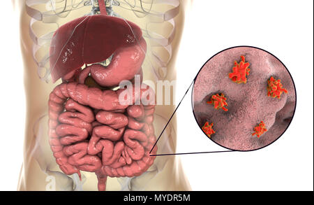 Amibe parasitaire (Entamoeba histolytica) dans le gros intestin, l'illustration de l'ordinateur. Cet organisme unicellulaire la dysenterie amibienne et ulcères (stade végétatif) trophozoïte. Il se transmet par contamination fécale des aliments et de l'eau et est plus commun où l'assainissement est pauvre. Les amibes envahissent l'intestin mais peut se répandre sur le foie, les poumons et d'autres tissus. L'infection est provoquée par l'ingestion de kystes qui se développent dans l'amibe trophozoïte pathogènes vus ici. Entamoeba histolytica est présente dans le monde entier, avec jusqu'à 50 % de la population infectée, principalement dans les climats chauds. Banque D'Images