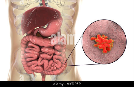 Amibe parasitaire (Entamoeba histolytica) dans le gros intestin, l'illustration de l'ordinateur. Cet organisme unicellulaire la dysenterie amibienne et ulcères (stade végétatif) trophozoïte. Il se transmet par contamination fécale des aliments et de l'eau et est plus commun où l'assainissement est pauvre. Les amibes envahissent l'intestin mais peut se répandre sur le foie, les poumons et d'autres tissus. L'infection est provoquée par l'ingestion de kystes qui se développent dans l'amibe trophozoïte pathogènes vus ici. Entamoeba histolytica est présente dans le monde entier, avec jusqu'à 50 % de la population infectée, principalement dans les climats chauds. Banque D'Images