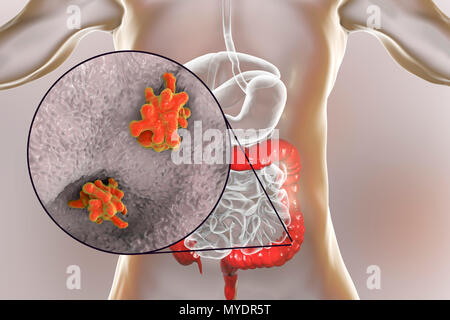 Amibe parasitaire (Entamoeba histolytica) dans le gros intestin, l'illustration de l'ordinateur. Cet organisme unicellulaire la dysenterie amibienne et ulcères (stade végétatif) trophozoïte. Il se transmet par contamination fécale des aliments et de l'eau et est plus commun où l'assainissement est pauvre. Les amibes envahissent l'intestin mais peut se répandre sur le foie, les poumons et d'autres tissus. L'infection est provoquée par l'ingestion de kystes qui se développent dans l'amibe trophozoïte pathogènes vus ici. Entamoeba histolytica est présente dans le monde entier, avec jusqu'à 50 % de la population infectée, principalement dans les climats chauds. Banque D'Images