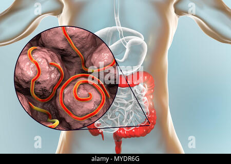 Threadworm infection. Illustration d'ordinateur montrant plusieurs threadworms (Enterobius sp.) dans l'intestin humain. Threadworms sont les vers nématodes qui parasitent le gros intestin et le caecum de nombreux animaux. Chez les humains qu'elles provoquent l'infection commune entérobiase. Les Nématodes sont des vers non segmentés qui peuvent être libres ou parasites vivant selon les espèces. Banque D'Images