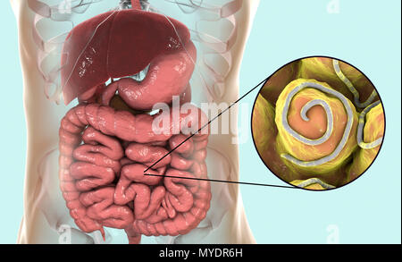 Threadworm infection. Illustration d'ordinateur montrant plusieurs threadworms (Enterobius sp.) dans l'intestin humain. Threadworms sont les vers nématodes qui parasitent le gros intestin et le caecum de nombreux animaux. Chez les humains qu'elles provoquent l'infection commune entérobiase. Les Nématodes sont des vers non segmentés qui peuvent être libres ou parasites vivant selon les espèces. Banque D'Images