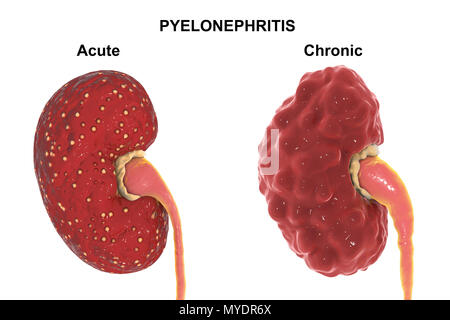 Comparaison de l'anatomie de la pyélonéphrite aiguë et chronique, de l'illustration. Il y a de petits abcès (jaune) sur la surface des reins avec une pyélonéphrite aiguë (à gauche). Le rein avec la pyélonéphrite chronique (à droite) a une surface corticale des cicatrices irrégulières, dilaté et émoussé les calices (jaune), et une dilatation de l'uretère. Banque D'Images