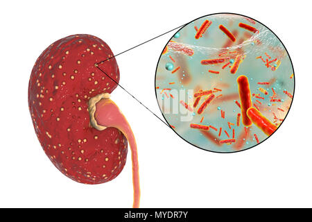 La pyélonéphrite aiguë. Illustration de petits abcès (jaune) sur la surface d'un rein dans un cas de pyélonéphrite aiguë. Les bactéries, les agents pathogènes d'une pyélonéphrite aiguë, sont vus en gros plan. La pyélonéphrite peut être aiguë ou chronique. La forme aiguë est habituellement causée lorsque les bactéries causant la propagation cystite uretères dans la vessie. Elle provoque de la fièvre et des douleurs au dos. Les causes les plus communes sont Escherichia coli, Enterococcus sp., Streptococcus sp., Staphylococcus sp. ou. Le traitement est avec des antibiotiques. Banque D'Images