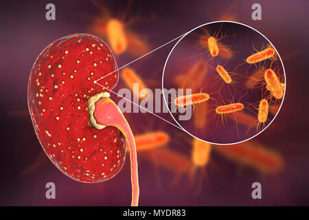 La pyélonéphrite aiguë. Illustration de petits abcès (jaune) sur la surface d'un rein dans un cas de pyélonéphrite aiguë. Les bactéries, les agents pathogènes d'une pyélonéphrite aiguë, sont vus en gros plan. La pyélonéphrite peut être aiguë ou chronique. La forme aiguë est habituellement causée lorsque les bactéries causant la propagation cystite uretères dans la vessie. Elle provoque de la fièvre et des douleurs au dos. Les causes les plus communes sont Escherichia coli (illustré ici), Enterococcus sp., Streptococcus sp., Staphylococcus sp. ou. Le traitement est avec des antibiotiques. Banque D'Images