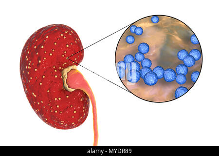 La pyélonéphrite aiguë causée par Enterococcus sp. des bactéries. Illustration de petits abcès (jaune) sur la surface d'un rein dans un cas de pyélonéphrite aiguë. La pyélonéphrite peut être aiguë ou chronique. La forme aiguë est habituellement causée lorsque les bactéries causant la propagation cystite uretères dans la vessie. Elle provoque de la fièvre et des douleurs au dos. Le traitement est avec des antibiotiques. Banque D'Images