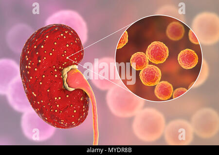 La pyélonéphrite aiguë causée par Enterococcus sp. des bactéries. Illustration de petits abcès (jaune) sur la surface d'un rein dans un cas de pyélonéphrite aiguë. La pyélonéphrite peut être aiguë ou chronique. La forme aiguë est habituellement causée lorsque les bactéries causant la propagation cystite uretères dans la vessie. Elle provoque de la fièvre et des douleurs au dos. Le traitement est avec des antibiotiques. Banque D'Images