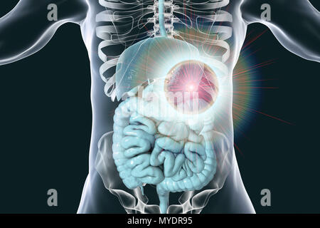 Traitement du cancer de l'estomac humain, ordinateur conceptuel illustration. Banque D'Images