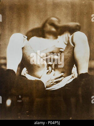 . Photographie d'un hermaphrodite montrant genetalia . L'hermaphrodisme . 186011 6 hermaphrodites par Nadar Banque D'Images