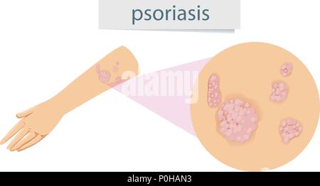 Psoriasis sur bras illustration agrandie Illustration de Vecteur