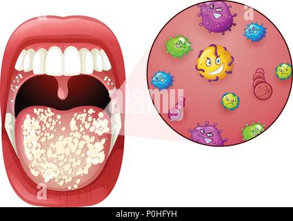 Une infection par le virus de l'illustration des bouche Illustration de Vecteur