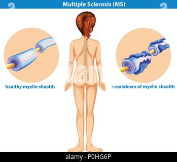 Un vecteur d'illustration de la sclérose en plaques Illustration de Vecteur