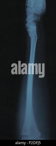 . Fracture du radius avec environ 10o inclinaison latérale. L'objet était de 11 ans de sexe masculin. 8 avril 2004. Ministère de la santé WA - hôpital public 44 patient Radius 10deg pause latérale gnangarra Banque D'Images