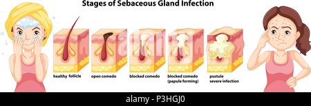 Un stades de l'infection des glandes sébacées illustration Illustration de Vecteur