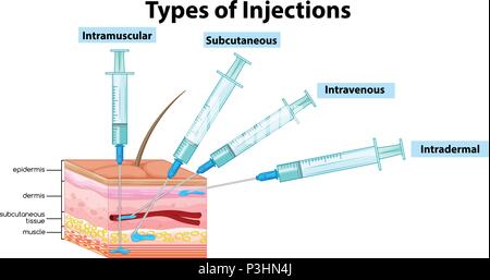 Types d'injections sur fond blanc illustration Illustration de Vecteur