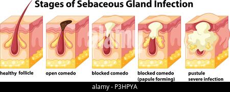 Étapes de l'infection des glandes sébacées illustration Illustration de Vecteur