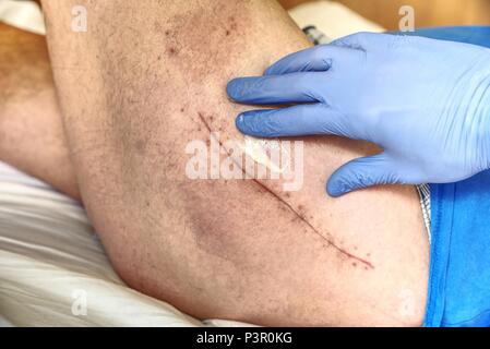 Patient avec une longue cicatrice fraîche après une chirurgie de la hanche. Macro, Human foot avec du sang cicatrice de chirurgie de la hanche. Banque D'Images