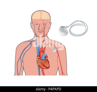 Stimulateur cardiaque. Coeur de l'homme coupe anatomique avec défibrillateur implantable de travail. Illustration de Vecteur