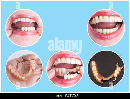 Avec la réhabilitation dentaire prothèse supérieure et inférieure, avant et après le traitement Banque D'Images
