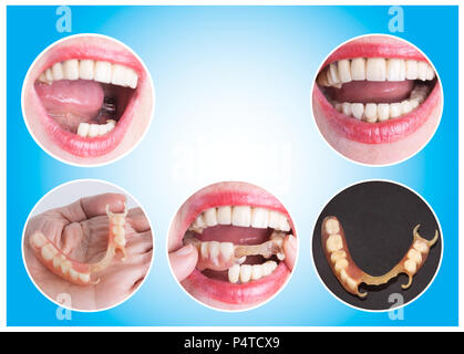 Avec la réhabilitation dentaire prothèse supérieure et inférieure, avant et après le traitement Banque D'Images