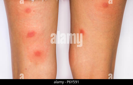 La jambe avec tache rouge causée par piqûre d'insecte / insectes ...