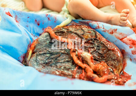 Placenta à l'extérieur de l'utérus après l'accouchement et juste le bébé à l'arrière-plan Banque D'Images