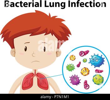 Une infection pulmonaire bactérienne garçon illustration Illustration de Vecteur